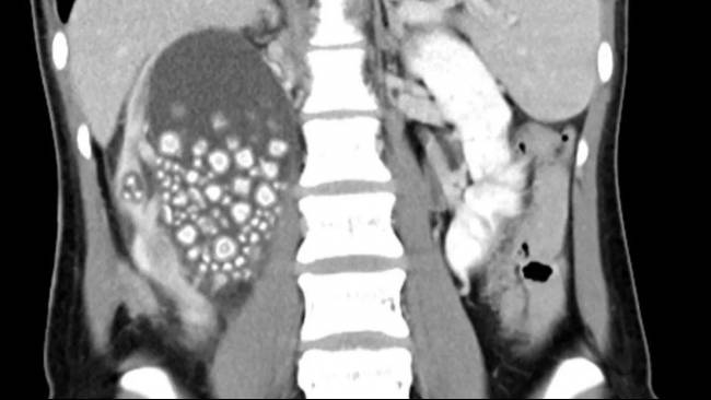 5 Kebiasaan Buruk yang Dapat Merusak Ginjal